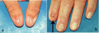 Figure 1. . Typical presentation of thumb nails (a) and fingernails (b) in nail-patella syndrome.