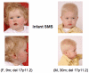 Figure 1. . Infants with SMS.