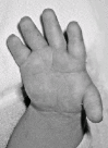 Figure 1. . Hand of a newborn with diastrophic dysplasia, showing brachydactyly (short fingers), absence of flexion creases of the fingers, and proximally placed, abducted "hitchhiker thumb.