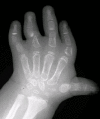 Figure 2. . Radiograph of the hand of a child, age three years, with diastrophic dysplasia.