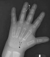 Figure 3. . Hand x-ray of a male age 2.