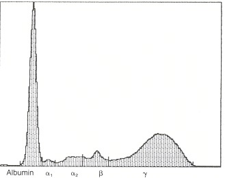 Figure 101.2. Serum protein electrophoresis with polyclonal gammopathy.