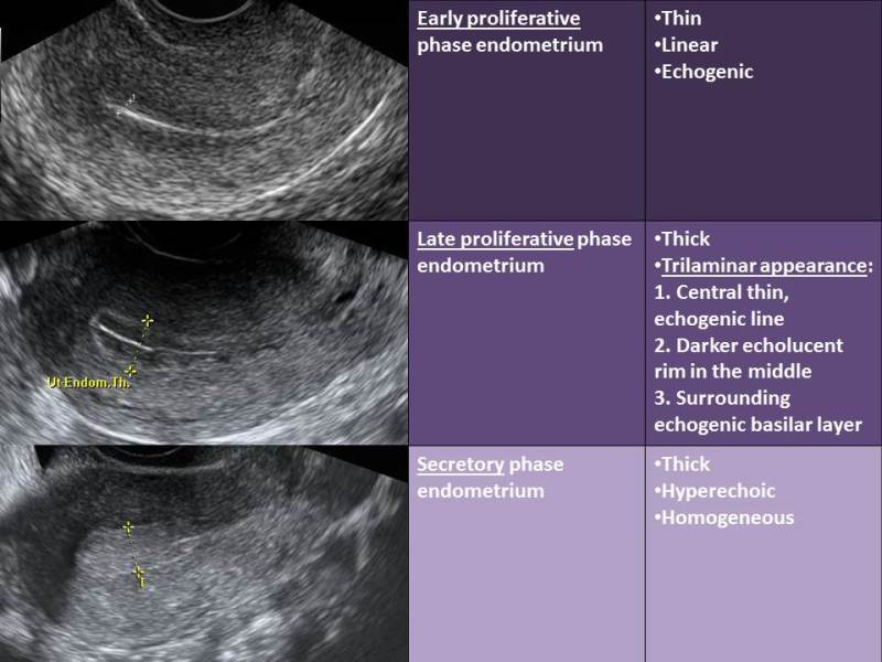 Figure 11. . Characteristic sonographic endometrial changes seen throughout the menstrual cycle.