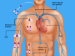 This image shows different access in the body for central venous catheterization