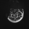 Cervical Spine MRI