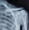 Acromioclavicular joint disruption Dr