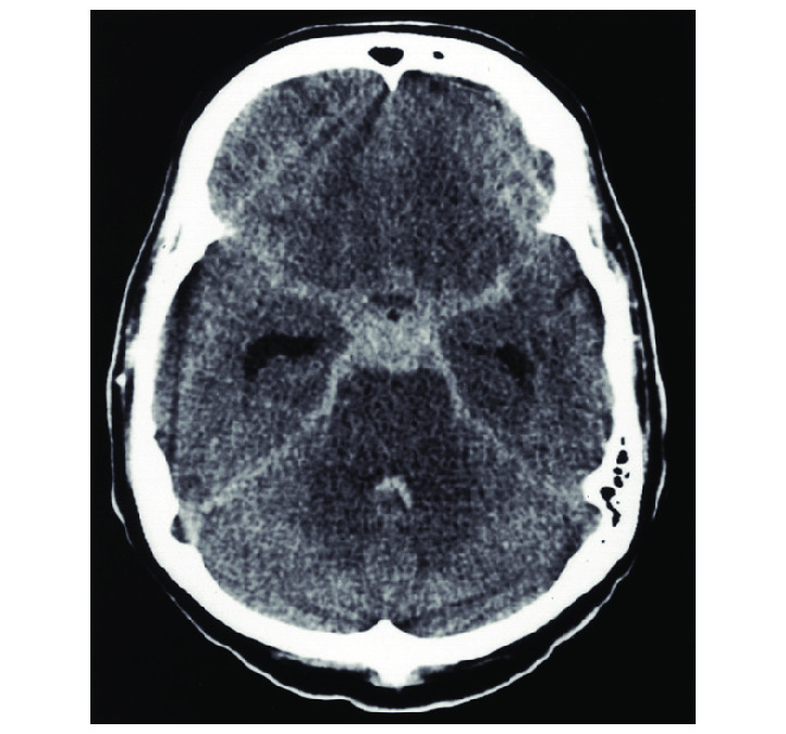 Acute Subarachnoid Hemorrhage Statpearls Ncbi Bookshelf