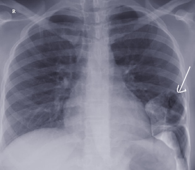 Diaphragmatic Hernia X Ray