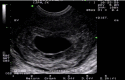 Endovaginal Ultrasound of the uterus in a coronal plane with a large empty gestational sac Contributed by Dr