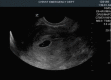 A retroverted uterus with a gestational sac (GS) within the endometrial echo of the uterus and contains a yolk sac (YS)