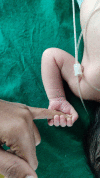 Palmar grasp reflex - a neonate tightly holding on to the examiner's finger after the palm was stroked