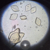 Uric acid Crystals in Urine Contributed by Iqbal Osman (CC by 2