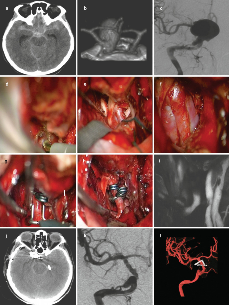 Fig Illustrative Case Regarding A Trends In Cerebrovascular Surgery And