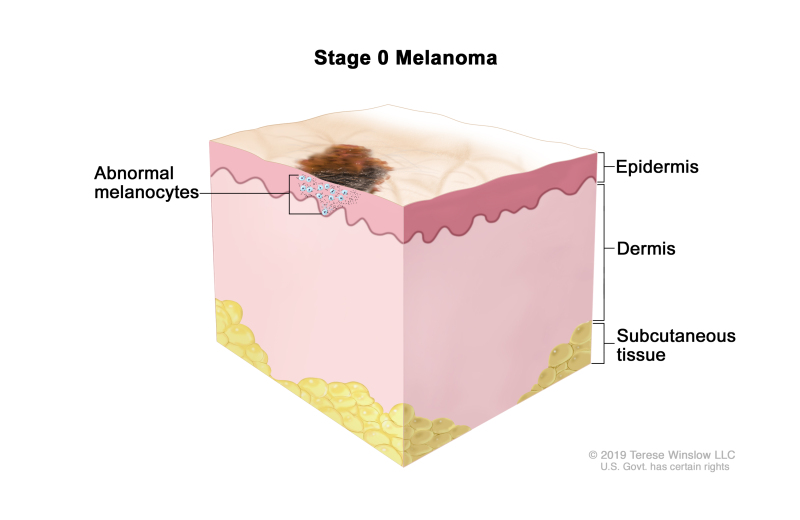 Stage 0 melanoma; drawing shows an abnormal area on the surface of the skin and abnormal melanocytes in the epidermis (outer layer of the skin). Also shown are the dermis (inner layer of the skin) and the subcutaneous tissue below the dermis.
