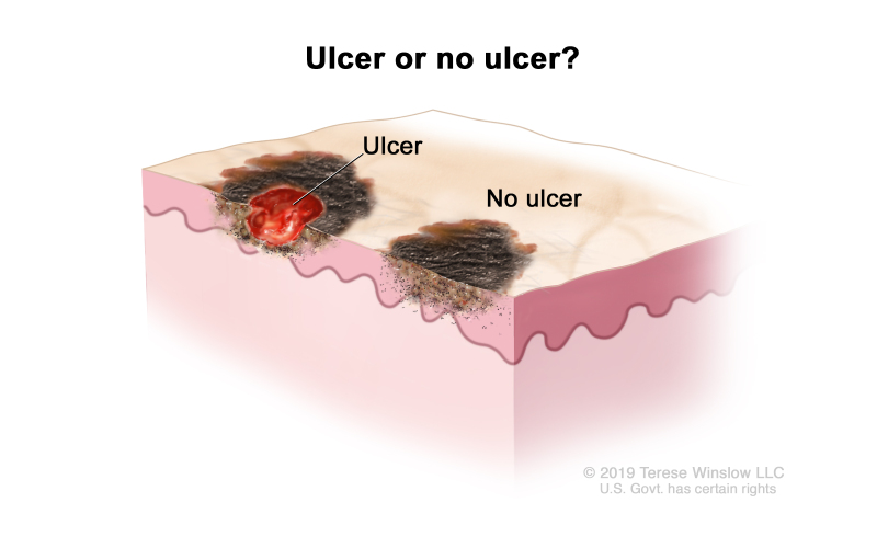 Melanoma staging (tumor ulceration); drawing shows a tumor that is ulcerated (has broken through the skin) and a tumor that is not ulcerated.