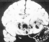 Figure 68-5. Hemorrhagic necrosis of the temporal lobe due to HSV encephalitis.