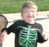 Figure 2. . Boy age seven years with Pitt-Hopkins syndrome (same individual as in Figure 1).