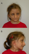Figure 1. . Facial appearance of a girl age 11 years with FHS (SRCAP pathogenic variant p.