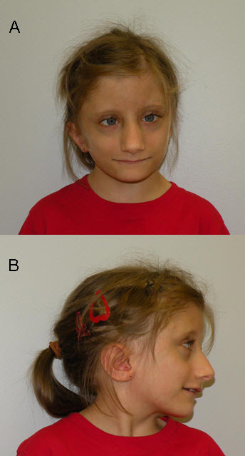 Figure 1. [Facial appearance of a girl age 11 years with FHS (SRCAP  pathogenic variant p.Arg2444Ter)]. - GeneReviews® - NCBI Bookshelf