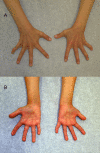 Figure 2. . Dorsal (A) and palmar (B) view of the hands of the girl in Figure 1.