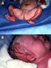Figure 2. . Child with epidermolysis bullosa with pyloric atresia and extensive aplasia cutis congenita of the extremities (A) and scalp (B).