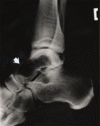 Figure 2. . A radiograph shows a well-demarcated cyst-like lesion (arrow) in the talus of a person with PLOSL, age 28 years.