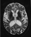 Figure 3. . T2-weighted MRI of a patient age 33 years shows very low signal intensity in the putamina.