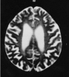 Figure 4. . T2-weighted MRI of a patient age 32 years displays severely enlarged cerebral sulci and lateral ventricles.