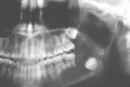 Figure 91-12. Orthopantomogram of odontogenic keratocyst with wide displacement of teeth, root resorption, and extensive bony destruction.