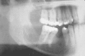 Figure 91-4. Ameloblastoma showing extensive destruction of the mandible and root resorption.