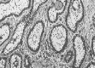 Figure 91-5. Photomicrograph of a follicular ameloblastoma ( ×100 magnification) showing typical pattern of palisading of epithelial cells.