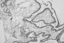 Figure 91-6. Photomicrograph of a plexiform ameloblastoma (hematoxylin and eosin ×100).