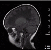 Figure 4. . Parasagittal T1-weighted MRI image of an individual with CACH/VWM shows diffuse hypointensity of the white matter interrupted by a typical meshwork of remaining tissue strands radiating across the abnormal white matter.