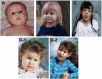Figure 2. . Four individuals with Emanuel syndrome.