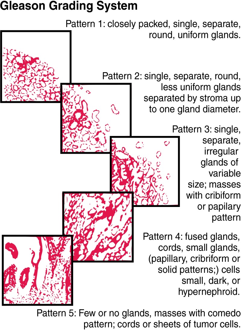 Figure 111-7. Histologic grading scheme for adenocarcinomas of the prostate.