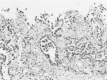 Figure 21-4. Tubular epitheliomorphic mesothelioma of the pleura in an Italian railroad machinist.