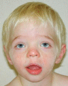 Figure 1. . AP view of a boy age two years with CLS showing relatively fine facial features but with widely spaced eyes, mildly downslanted palpebral fissures, short nose with broad columella, and thick, slightly everted vermilion of the lips (Affected individual has a known RPS6KA3 pathogenic variant.
