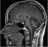 Figure 1. . MRI of a female age 29 years with SYNE1 adult-onset cerebellar ataxia.