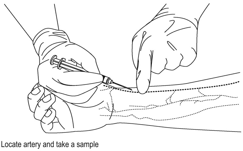 Figure 5.1. Arterial blood sampling.