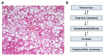 Figure 1. Overview of fatty liver disease.