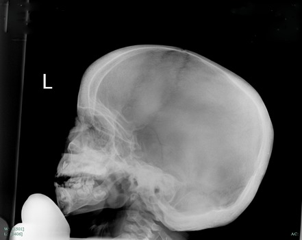 Craniometaphyseal dysplasia radiology