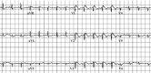 Figure 1. . Characteristic EKG in Brugada syndrome.