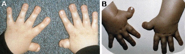 First case report of inherited Rubinstein-Taybi syndrome
