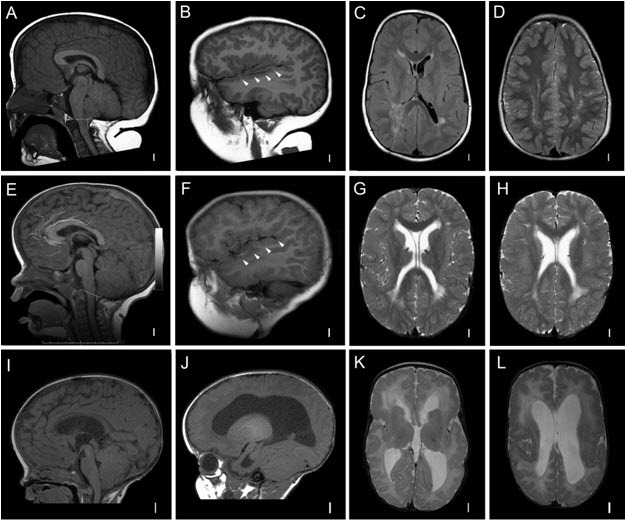Figure 4. . Characteristic brain MRI of MCAP syndrome in three individuals (A-D, E-H, and I-L).