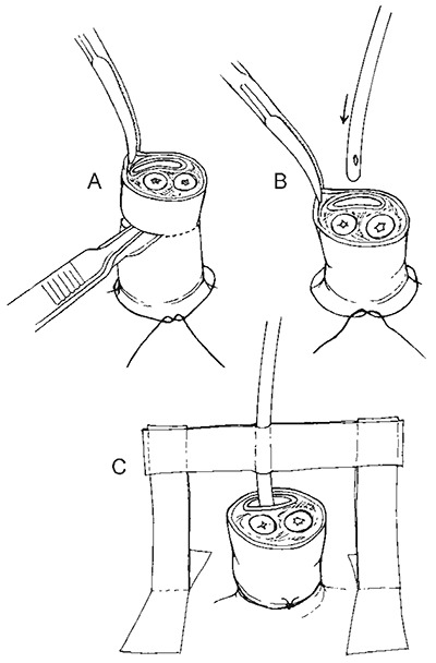 Inserting an umbilical vein catheter.