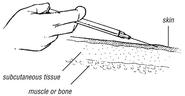 Intradermal injection (for example in Mantoux test).