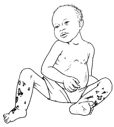 Child with severe acute malnutrition oedema.