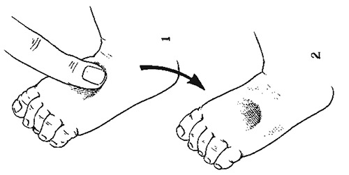 Pitting oedema on dorsum of foot.