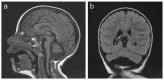 Figure 1. . MRI of the brain of a girl age 2.