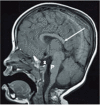 Figure 2. . MRI in a female age three years demonstrates numerous abnormalities including hypogenesis of the corpus callosum (most notably involving the rostrum and splenium) (long white arrow), partially empty sella turcica (S), and small pons (P).